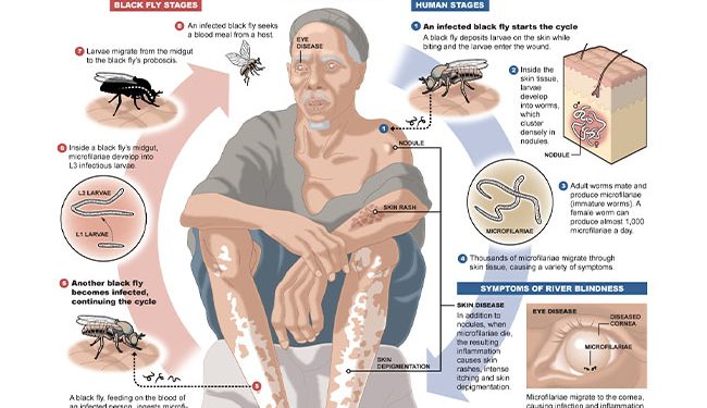 World NTDs Day: Gombe faces high risks of Biharzia, River Blindness, Elephantiasis, say experts