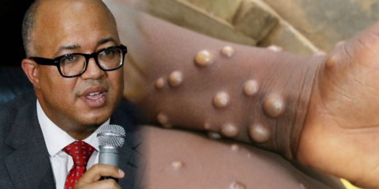 FLASH: NCDC confirms monkeypox in Nigeria, registers 59 cases