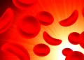 Tackling sickle cell and hepatitis in Nigeria