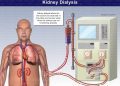 Senate wants NHIS coverage as 25 million Nigerians battle kidney disease