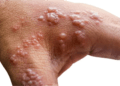 Congo approves 2 monkeypox vaccines amid deadly spread of new strain