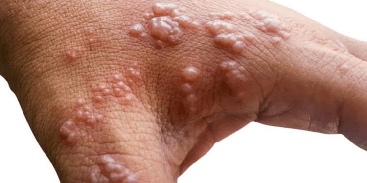 Congo approves 2 monkeypox vaccines amid deadly spread of new strain