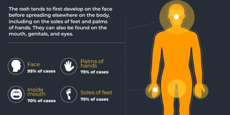 What is mpox and why has WHO declared it a global health emergency?