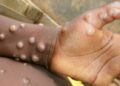 Africa CDC declares mpox public health emergency