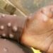 Africa CDC declares mpox public health emergency
