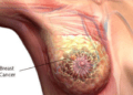 Experts, survivor harp on early detection to enhance cancer treatment