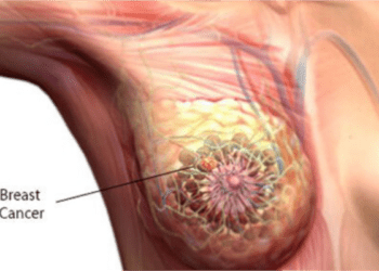 Experts, survivor harp on early detection to enhance cancer treatment