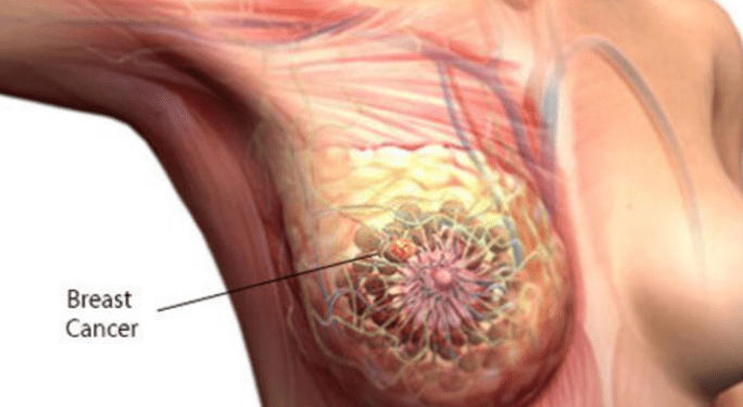 Experts, survivor harp on early detection to enhance cancer treatment