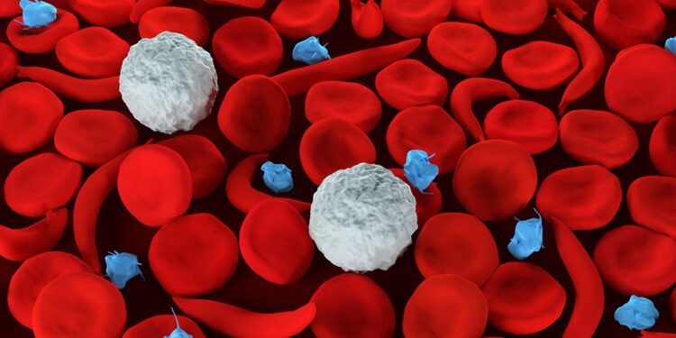 138,000 children born annually with sickle cell disease, says KESCA