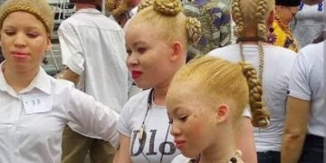 Nigeria’s albinos seek support over skin cancer
