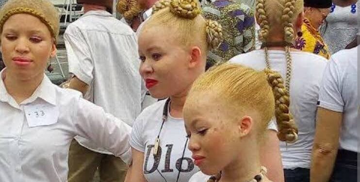 Nigeria’s albinos seek support over skin cancer