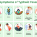 Experts recommend urgent action against typhoid outbreaks