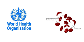 WHO issues guideline on pregnancy care for women with sickle cell disease