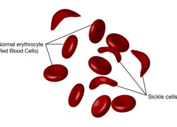 Lagos sickle cell groups urge mandatory screening