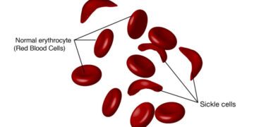 Lagos sickle cell groups urge mandatory screening