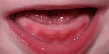 Teething not cause of stooling in infants, experts say