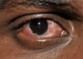 Yobe: Authorities issue alert as conjunctivitis reaches epidemic level in Potiskum