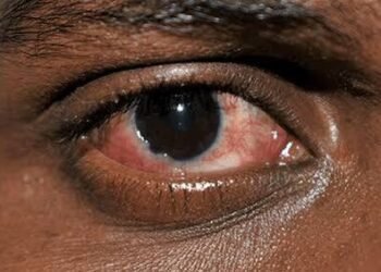 Yobe: Authorities issue alert as conjunctivitis reaches epidemic level in Potiskum