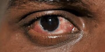 Yobe: Authorities issue alert as conjunctivitis reaches epidemic level in Potiskum