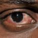 Yobe: Authorities issue alert as conjunctivitis reaches epidemic level in Potiskum