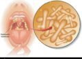 Diphtheria: ‌‍⁠Zamfara begins house-to-house response campaign