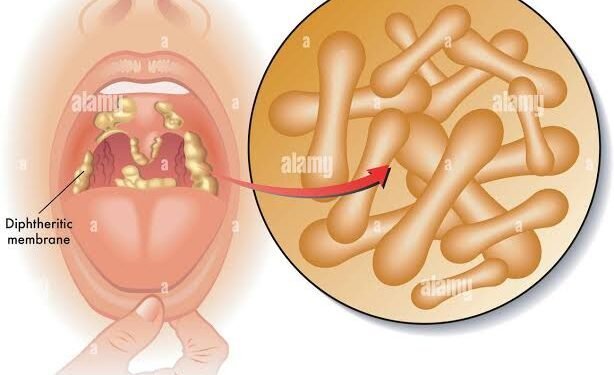 Diphtheria: ‌‍⁠Zamfara begins house-to-house response campaign
